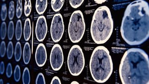 Amerikai gyógyszerügyi hatóság: agyi problémákat okozhatnak a pubertás blokkolók